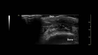 Cobblestone appearance in subcutaneous edema [upl. by Baerman]