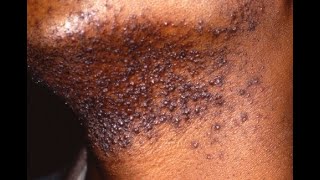 PSEUDOFOLLICULITIS BARBAE Razor Bumps Symptoms Causes Treatment [upl. by Nimesh]