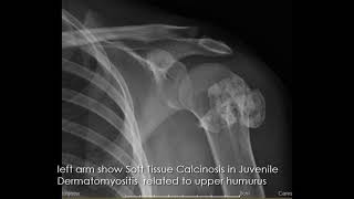 CASE 940 Soft Tissue Calcinosis in Juvenile Dermatomyositis [upl. by Ennairac925]