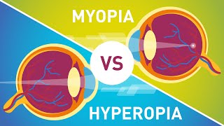 Difference between Myopia Near Sightedness amp Hyperopia FarSightedness [upl. by Nilpik413]