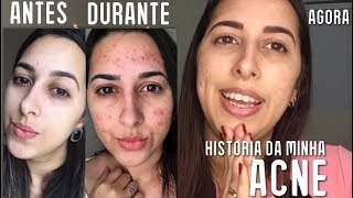 Antes e depois das espinhas tratamento para acne sem roacutan [upl. by Asoj]