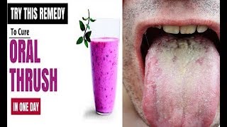 How to Get Rid of Oral Thrush with Home Remedies [upl. by Gawlas]