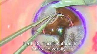 DALK Big Bubble Technique for superficial corneal opacityTAREK KATAMISHwmv [upl. by Dittman238]