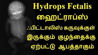 Hydrops Fetalis ஹைட்ராப்ஸ் ஃபிட்டாலிஸ் கருவுக்குள் இருக்கும் குழந்தைக்கு ஏற்பட்டு ஆபத்தாகும் [upl. by Esinehc553]