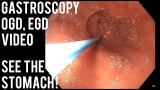 Gastroscopy  OGD  See inside the stomach [upl. by Bashuk111]