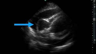 Cardiac Tamponade [upl. by Raddie]