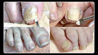 2 POV Salon Pedicure Compilation Big Toenail Cleaning ✔ [upl. by Darcie]