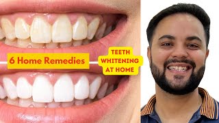 6 Natural Remedies for Teeth Whitening at Home [upl. by Onitnatsnoc]