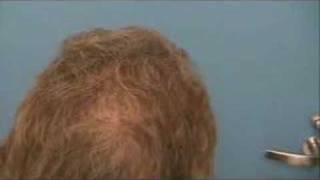 Hair Transplant  Results  7218 Grafts  Hasson amp Wong [upl. by Baniez]