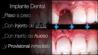 Implante Dental Paso a paso Extracción  Implante  Encía  Hueso  Diente inmediato Única cirugía [upl. by Plantagenet272]