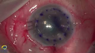 UTDSAEK for bullous keratopathy on pseudophakic eye with Baerveldt tube [upl. by Ultima]