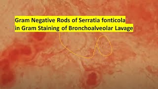 Gram Negative Rods of Serratia fonticola in Gram Staining of Bronchoalveolar Lavage [upl. by Martres]