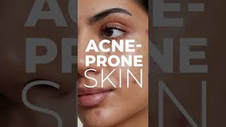 AcneProne Skin Care Routine5 easy Tips to followshorts acnetreatment acnetipsskincareroutine [upl. by Dowd]