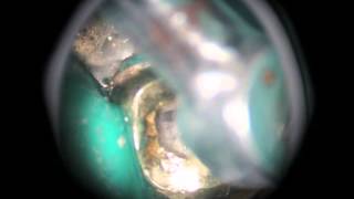 Endodontic Access Maxillary First Molar [upl. by Gorton]