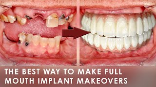 The Best Way to make Full Mouth Implant Makeover Cases [upl. by Hercules]