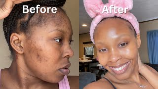 How I Cleared My Acne  Dark Spots  Hyperpigmentation for good in 1 month NO ACCUTANE VIDEO PROOF [upl. by Laen]