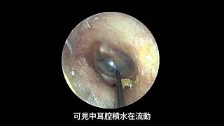 中耳積水執行耳膜穿刺抽吸。 Tympanic aspiration for a patient of otitis media with effusion [upl. by Aix]