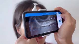 Check meibomian gland with smartphone meibographer MeiboVue [upl. by Hanley]