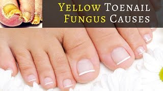 What Causes Yellow Toenail Fungus WARNING Find Out What Causes Yellow Toenail Fungus [upl. by Goulder543]