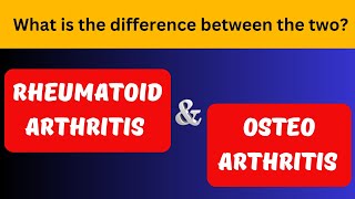 Osteoarthritis and rheumatoid arthritis are both types of arthritis [upl. by Naghem]