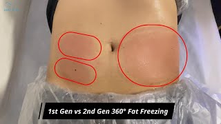 1st Gen Fat Freezing vs 2nd Gen 360° Fat Freezing Cryolipolysis [upl. by Swirsky908]