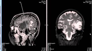 Homonymous hemianopsia caused by tumor [upl. by Anoyk]