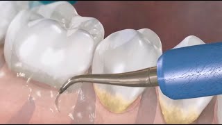 ¿Qué es la periodoncia y como tratarla I Clínica Dental Mas Bermejo Murcia [upl. by Anidem]