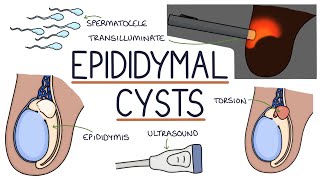 Understanding Epididymal Cysts [upl. by Chapell]