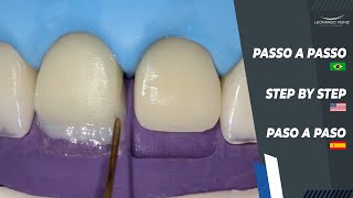 Diastema and Incisal Increase I Diastema y Alargamiento Incisal I Diastema e Aumento Incisal [upl. by Ecam]