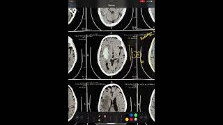 CT BRAIN  PUTAMEN BLEED  BASAL GANGLIA HEMORRHAGE TYPICAL HYPERTENSIVE BLEED HEMORRHAGE [upl. by Nyrhtak]