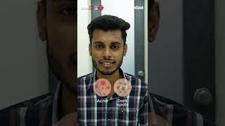 Two Months to Clear Skin An Inspiring Transformation Story  Clear Skin Clinic Pune [upl. by Ahtiek105]