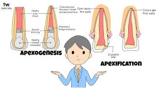 Apexogenesis and Apexification Mastering Endodontic Procedures as a Dental Student [upl. by Eniawed811]