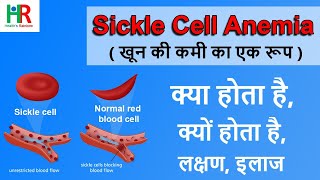 Sickle Cell Anemia  Sickle Cell Anemia in hindi  sickle cell anemia treatment in hindi  cause [upl. by Ibok739]