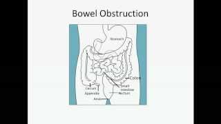 Bowel Obstruction  USMLE Step 2 Review [upl. by Ayor795]