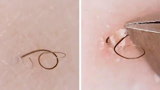 Compilation Of Ingrown Hairs In Girls Leg [upl. by Aicilf]