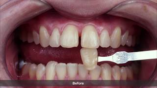 ENG Whitening and diastema closure with Whiteness HP AutoMixx and Vittra APS [upl. by Aihtnamas393]