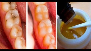 Cómo quitar las caries de forma casera [upl. by Lamok]