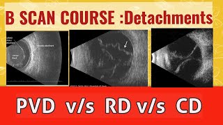 B scan course  differentiate retinal detachment from vitreous detachment and choroidal detachment [upl. by Castera881]