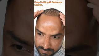 Washing  Cleaning after hair transplant  9416500112 [upl. by Beauchamp]