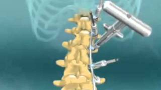 Scoliosis Spinal Fusion Animation [upl. by Barrington]