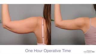 Get Firm Sculpted Arms With Smartlipo™  Dr Sterry Explains [upl. by Araes]