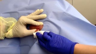 Abscess Drainage Performed by Dermatologist Dr David Myers [upl. by Adirehs]