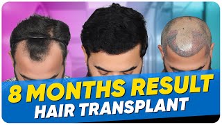 Hair Transplant in Guwahati  Best Results amp Cost of Hair Transplant in Guwahati [upl. by Rohclem]