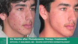 Dr Goldman Patient Testimonial  Photodynamic Therapy Laser Treatment for Acne [upl. by Nolahs]