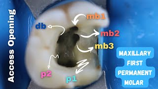 How To Find Mesiobuccal Canals mb1mb2mb3 Easily 🟡 Access Opening iin maxillary first molar [upl. by Auqinot213]