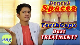 DENTAL SPACES AND GAPS TreatmentsREVEALED and EXPLAINED [upl. by Kenwee]