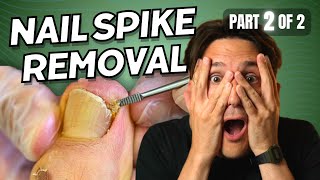 Ingrown Toenail Spike Removal part 2 of 2 [upl. by Ahsemak]