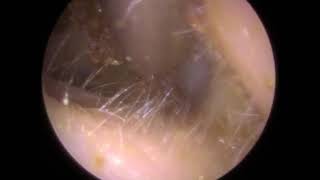 Elastic Ear Wax Removal using Endoscopic Microsuction  331 [upl. by Hna]