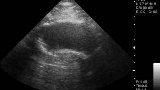 abdominal aortic aneurysm doppler ultrasoundwmv [upl. by Nirhtak613]