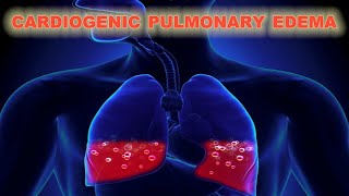 Pulmonary Edema  causes symptoms diagnosis treatment pathology [upl. by Giliane]